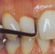 Tandlægen/tandplejeren måler tandkødslommens (pochens) dybde med en pochemåler.